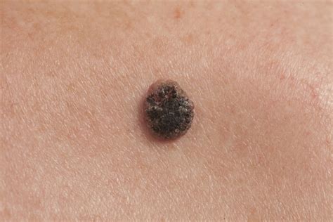 show me a picture of a mole|Types of Moles: Noncancerous and Cancerous Pictures